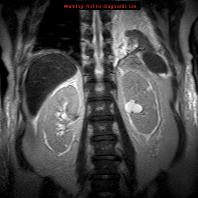 File:Acute pancreatitis with incidental pancreatic lipoma (Radiopaedia 10190-10732 Coronal T2 25).jpg