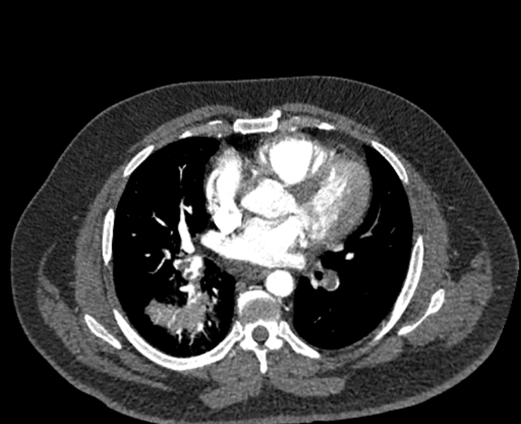 Acute pulmonary embolism with pulmonary infarcts (Radiopaedia 77688-89908 Axial C+ CTPA 34).jpg