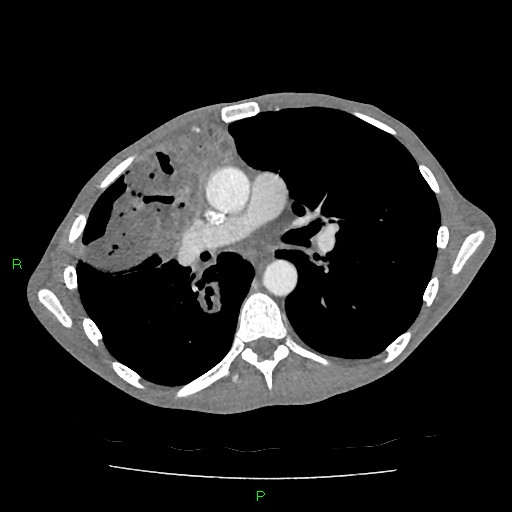 File:Acute right lung abscess (Radiopaedia 34806-36258 Axial C+ arterial phase 89).jpg