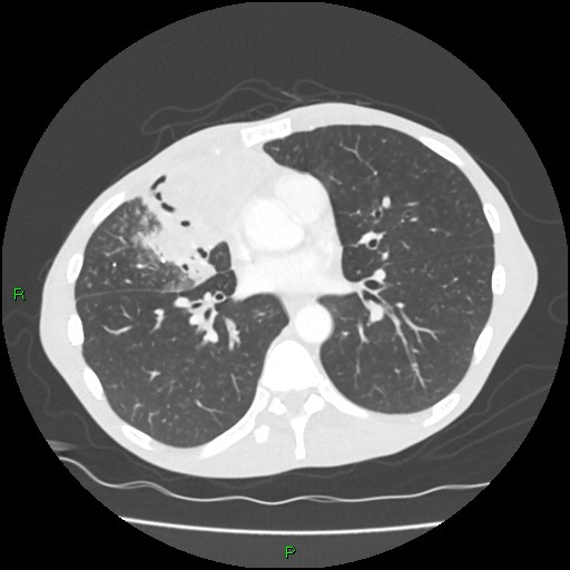 Acute right lung abscess (Radiopaedia 34806-36258 Axial lung window 107).jpg