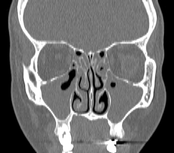 Acute sinusitis (Radiopaedia 40564-43158 Coronal bone window 18).jpg