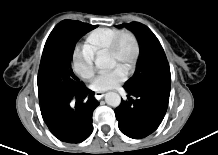 Acute small bowel (ileal) volvulus (Radiopaedia 71740-82139 Axial C+ portal venous phase 21).jpg