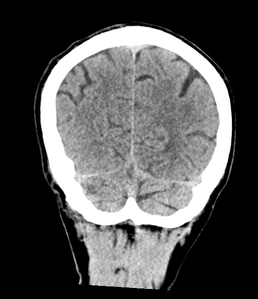 File:Acute superior cerebellar artery territory infarct (Radiopaedia 84104-99359 Coronal non-contrast 71).jpg