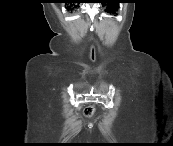 Acute superior mesenteric artery occlusion (Radiopaedia 43926-47418 Coronal C+ portal venous phase 47).png