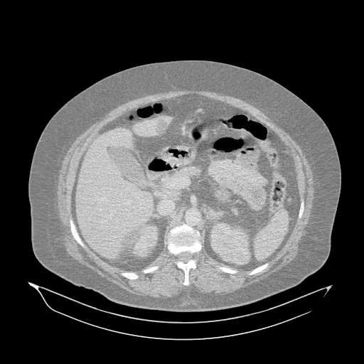 Acute superior mesenteric artery occlusion (Radiopaedia 51288-56960 Axial lung window 12).jpg
