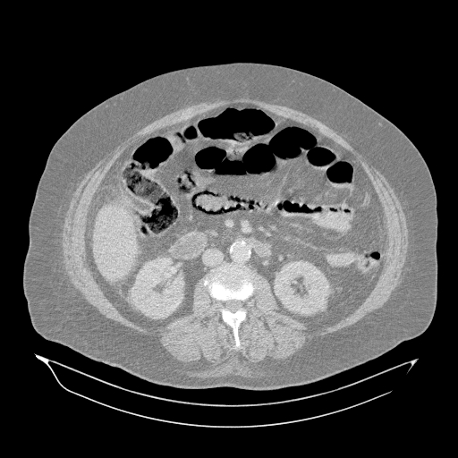 Acute superior mesenteric artery occlusion (Radiopaedia 51288-56960 Axial lung window 27).jpg