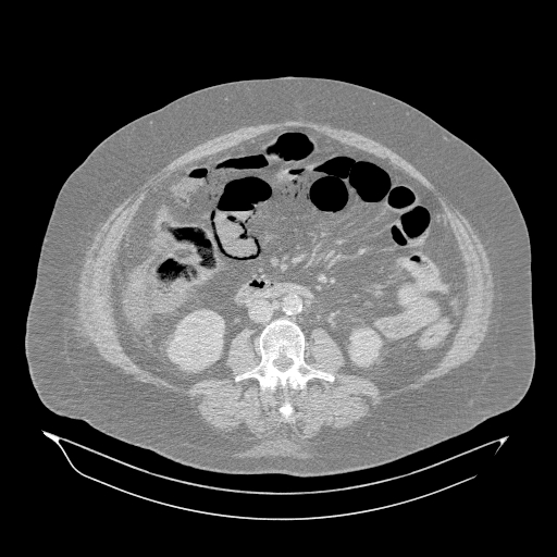 Acute superior mesenteric artery occlusion (Radiopaedia 51288-56960 Axial lung window 32).jpg