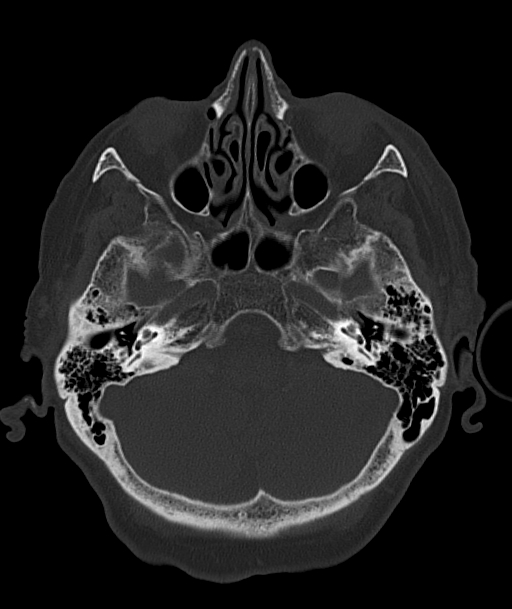 Acute traumatic subdural hematoma (Radiopaedia 82921-97257 Axial bone window 83).jpg