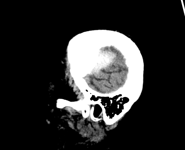 Acute traumatic subdural hematoma (Radiopaedia 82921-97257 Sagittal non-contrast 13).jpg