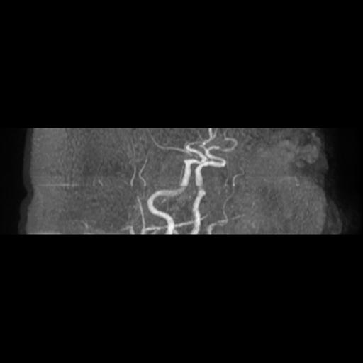 Acute vertebrobasilar ischemic infarction (Radiopaedia 25220-25474 Axial MRA 18).jpg