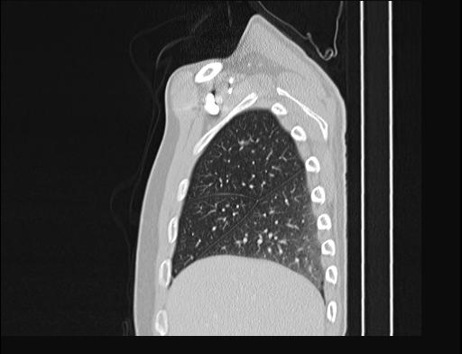 File:Addison disease (Radiopaedia 49318-54412 Sagittal lung window 53).jpg