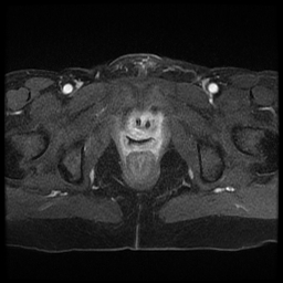 File:Adenocarcinoma arising in a urethral diverticulum (Radiopaedia 12400-12657 Axial T1 C+ fat sat 8).jpg
