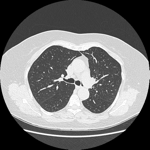 Adenocarcinoma in situ of lung (Radiopaedia 38685-40829 B 88).png