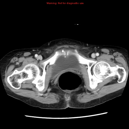 Adenocarcinoma of the colon (Radiopaedia 8191-9039 Axial liver window 73).jpg