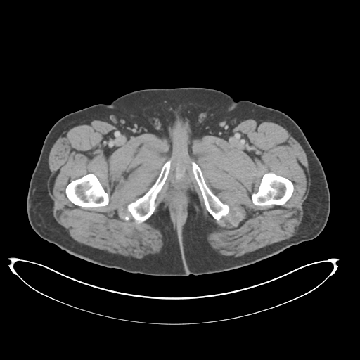 Adenocarcioma of rectum- T1 lesion (Radiopaedia 36921-38547 Axial C+ portal venous phase 96).png