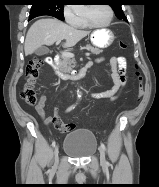 Adenocarcioma of rectum- T1 lesion (Radiopaedia 36921-38547 Coronal C+ portal venous phase 28).png