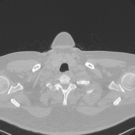 Adenoid cystic carcinoma of the trachea (Radiopaedia 49042-54137 Axial lung window 7).jpg