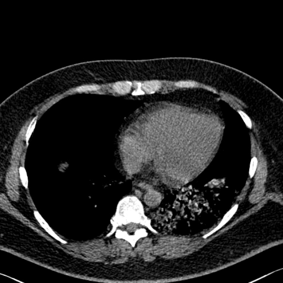 Adenoid cystic carcinoma of the trachea (Radiopaedia 49042-54137 Axial non-contrast 239).jpg