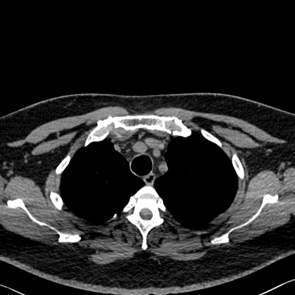File:Adenoid cystic carcinoma of the trachea (Radiopaedia 49042-54137 Axial non-contrast 66).jpg