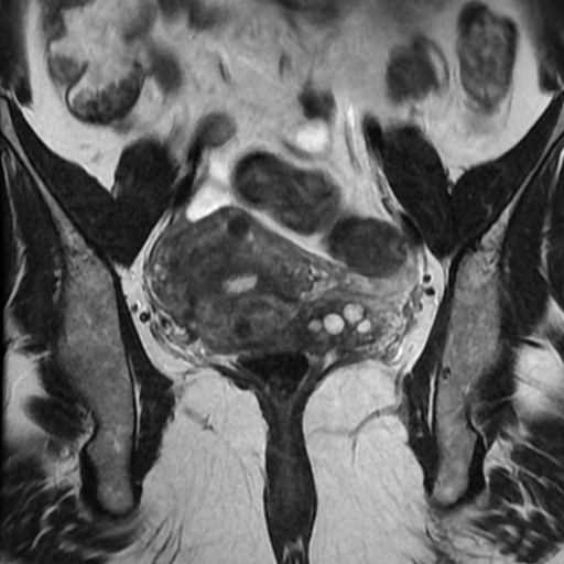 File:Adenoma malignum of cervix (Radiopaedia 66441-75705 Coronal T2 11).jpg
