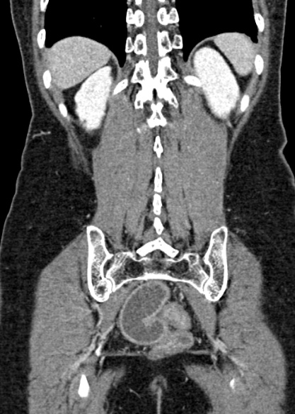 Adhesional small bowel obstruction (Radiopaedia 48397-53305 Coronal C+ portal venous phase 284).jpg