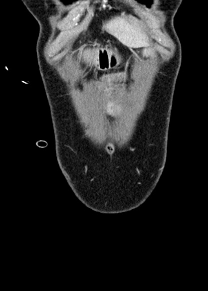 Adhesional small bowel obstruction (Radiopaedia 48397-53305 Coronal C+ portal venous phase 37).jpg