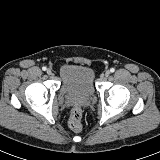 Adhesional small bowel obstruction (Radiopaedia 58900-66131 Axial C+ portal venous phase 51).jpg