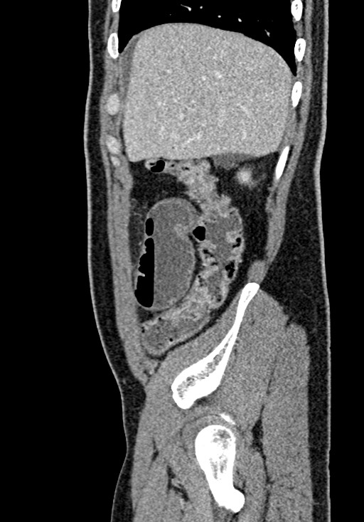 Adhesional small bowel obstruction (Radiopaedia 58900-66131 Sagittal C+ portal venous phase 47).jpg