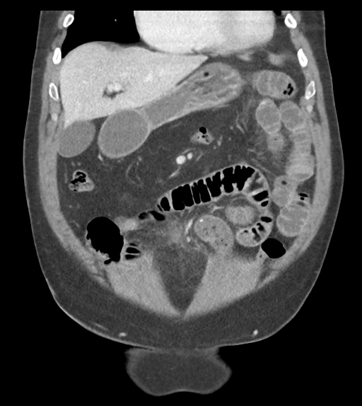 Adhesions within abdominal wall hernia (Radiopaedia 58283-65394 Coronal C+ portal venous phase 25).png