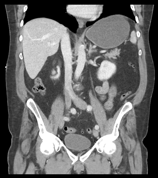 Adhesions within abdominal wall hernia (Radiopaedia 58283-65394 Coronal C+ portal venous phase 40).png