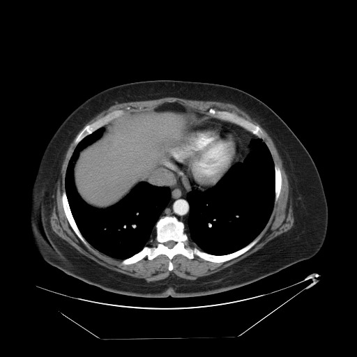 Adrenal angiosarcoma (Radiopaedia 81081-94671 Axial C+ arterial phase 6).jpg