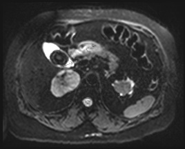 File:Adrenal cortical carcinoma (Radiopaedia 64017-72770 Axial DWI 15).jpg