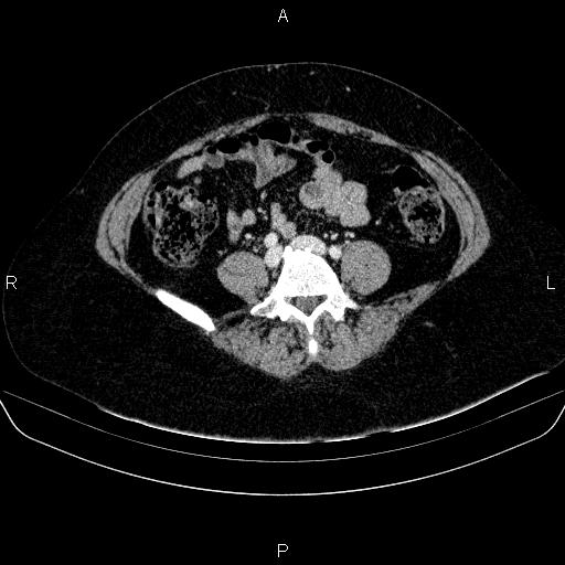 File:Adrenal cortical carcinoma (Radiopaedia 84882-100379 Axial C+ portal venous phase 61).jpg