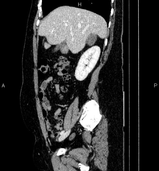 Adrenal cortical carcinoma (Radiopaedia 84882-100379 Sagittal C+ portal venous phase 27).jpg