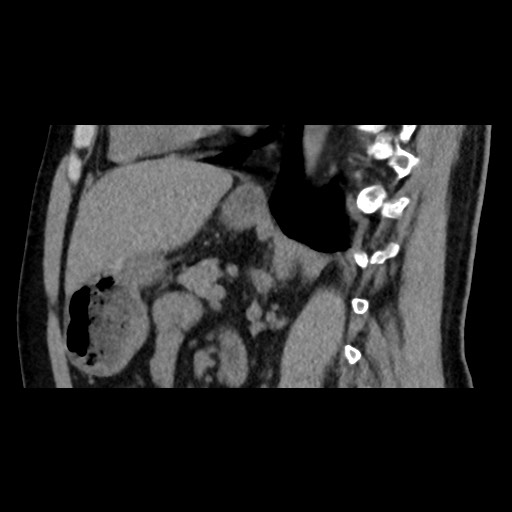 File:Adrenal gland trauma (Radiopaedia 81351-95079 Sagittal non-contrast 59).jpg