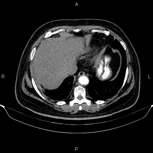 Adrenal hemorrhage (Radiopaedia 62622-70916 Axial C+ arterial phase 32).jpg