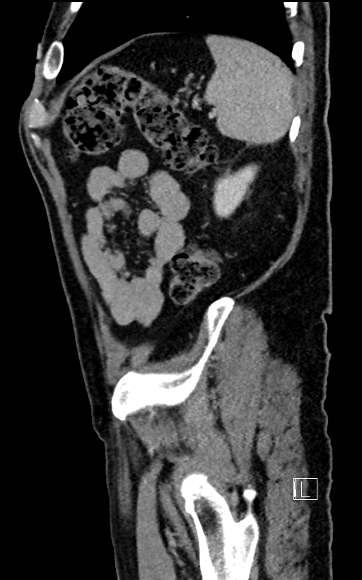 Adrenal lymphoma (Radiopaedia 73730-84529 Sagittal C+ portal venous phase 93).jpg
