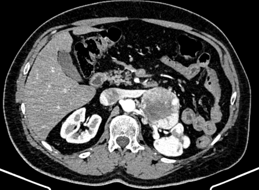 Adrenal metastases (Radiopaedia 73082-83791 Axial C+ arterial phase 63).jpg