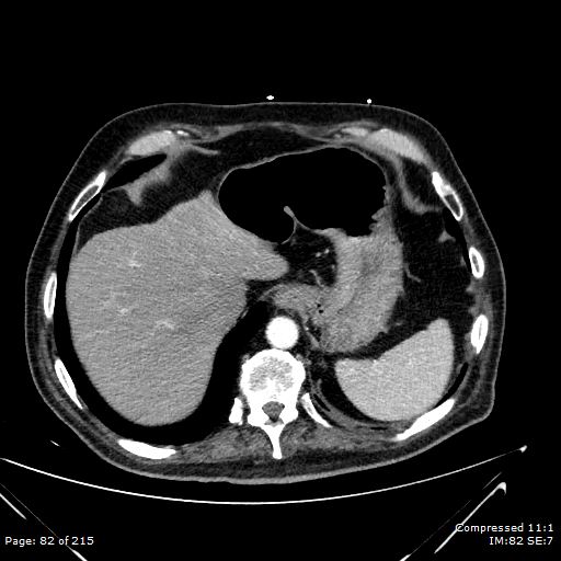 Adrenal metastasis (Radiopaedia 78425-91079 Axial C+ arterial phase 12).jpg