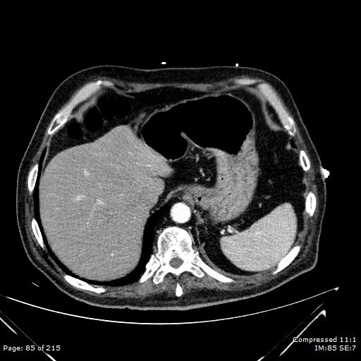Adrenal metastasis (Radiopaedia 78425-91079 Axial C+ arterial phase 15).jpg