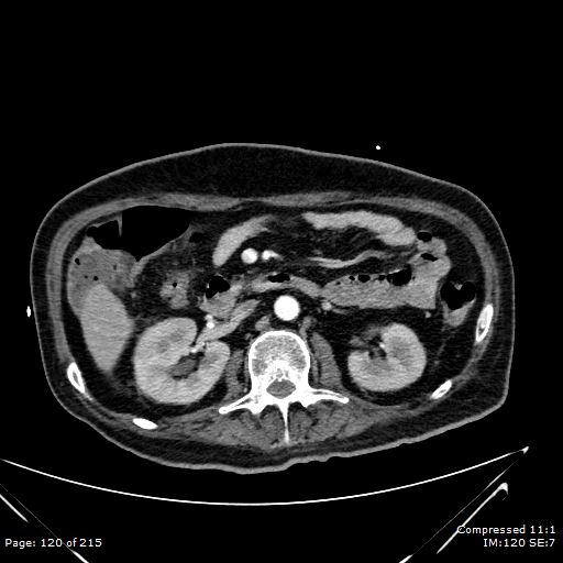Adrenal metastasis (Radiopaedia 78425-91079 Axial C+ arterial phase 50).jpg