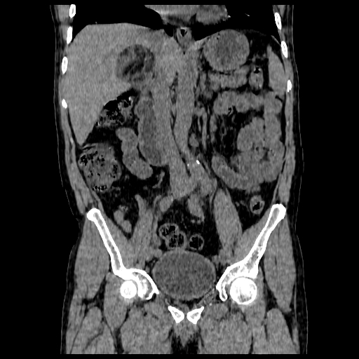 File:Adrenal myelolipoma (Radiopaedia 41843-44834 Coronal non-contrast 2).jpg