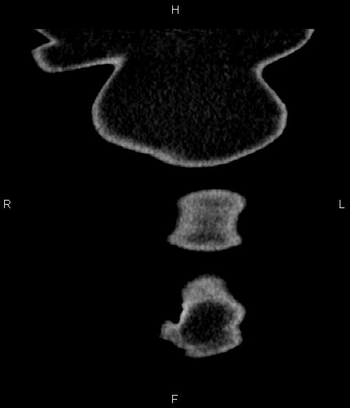 File:Adrenal myelolipoma (Radiopaedia 82742-96986 Coronal renal cortical phase 2).jpg