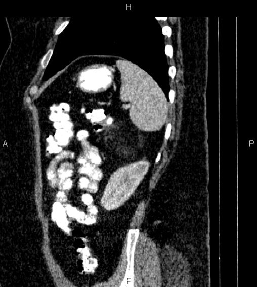 Adrenal myelolipoma (Radiopaedia 84319-99617 Sagittal renal cortical phase 79).jpg