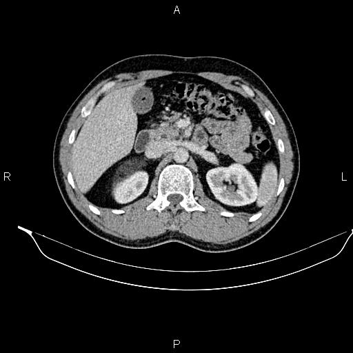 Adrenal myelolipoma (Radiopaedia 87794-104246 Axial renal cortical phase 38).jpg