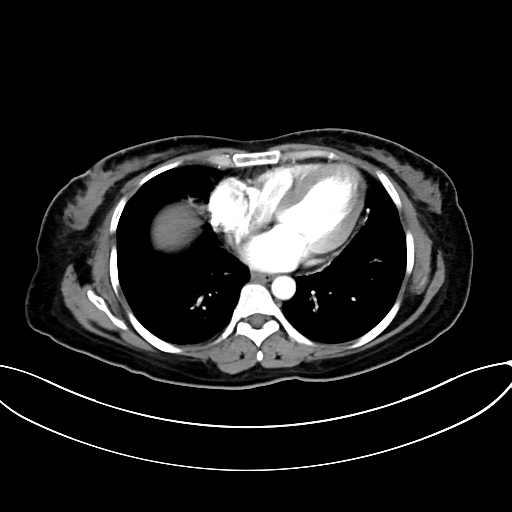Adrenocortical carcinoma (Radiopaedia 87281-103569 Axial C+ arterial phase 7).jpg