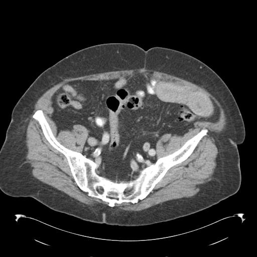 Adult ileal intussusception with secondary obstruction (Radiopaedia 30395-31051 Axial C+ portal venous phase 61).jpg