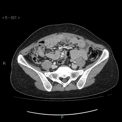 File:Adult transient intestinal intussusception (Radiopaedia 34853-36310 Axial C+ portal venous phase 71).jpg