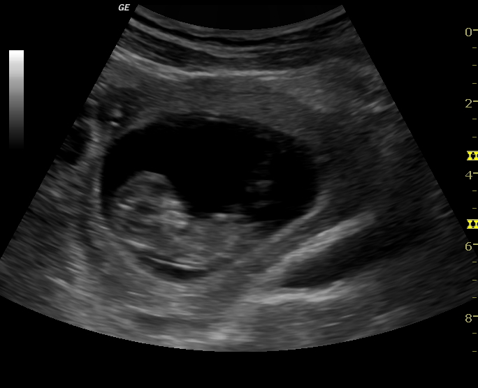 File:Advanced ectopic pregnancy (Radiopaedia 12862-12983 F 1).jpg