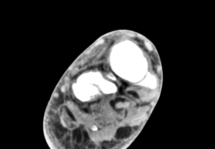 Advanced osteomyelitis due to open metatarsal fracture (Radiopaedia 83891-99095 Axial non-contrast 16).jpg